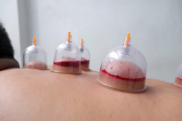 Asian male lying down as a therapist performs cupping therapy, with several cups placed on his...