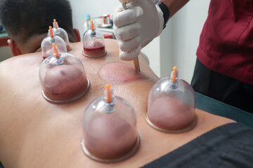 Asian male lying down as a therapist performs cupping therapy, with several cups placed on his back. Traditional treatment for muscle relief, relaxation, and improved circulation