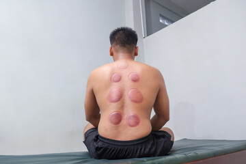 Asian man showing his back with reddish-purple marks after cupping therapy. Traditional healing method often used for muscle pain, fatigue, and circulation improvement
