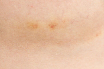 Fototapeta premium A person's arm with a rash on it