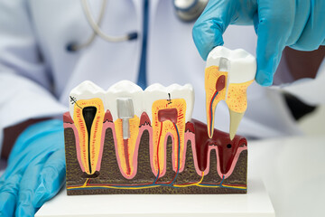 Asian dentist holding dental implant, artificial tooth roots into jaw, root canal of dental...