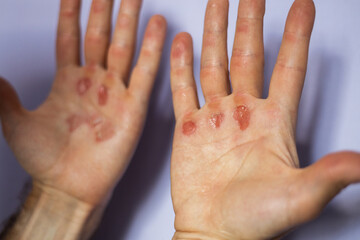 Man's hand with callus wound.