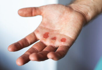 Man's hand with callus wound.
