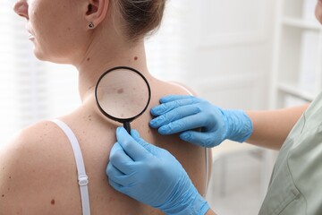 Doctor examining woman's moles in hospital, closeup