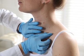 Doctor examining woman's moles in hospital, closeup