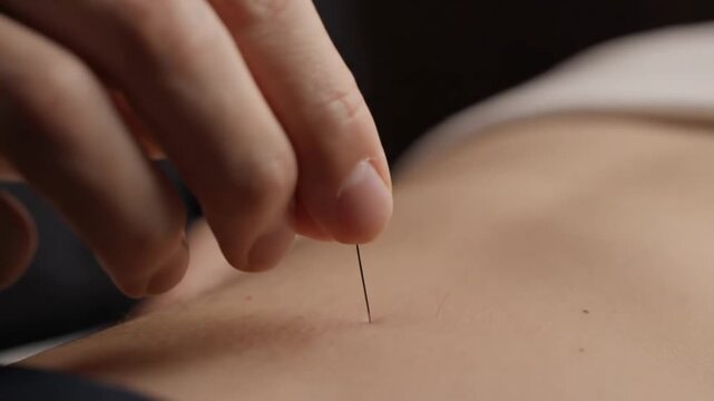 Acupuncture needle treatment close up alternative medicine therapy session