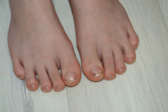 child's feet with uncut and dirty nails