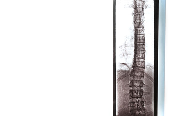 X-ray of the bones of the back of the vertebrae, lungs and chest in case of scoleosis and curvature of the spine.