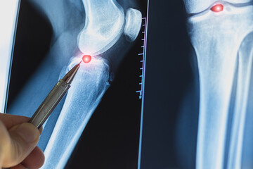 Doctor examining X-ray scan of knee joint. Exostosis on tibia. Cyst formation in the form of a Becker cyst.