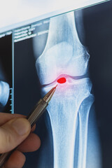 Doctor examining X-ray scan of knee joint. Exostosis on tibia. Cystic formation in the form of a Becker cyst. Vertical photo.