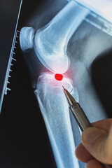 Doctor examining X-ray scan of knee joint. Exostosis on tibia. Cystic formation in the form of a Becker cyst. Vertical photo.