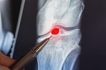 Doctor examining X-ray scan of knee joint. Exostosis on tibia. Cyst formation in the form of a Becker cyst.