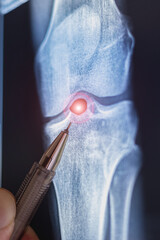 Doctor examining X-ray scan of knee joint. Exostosis on tibia. Cystic formation in the form of a Becker cyst. Vertical photo.