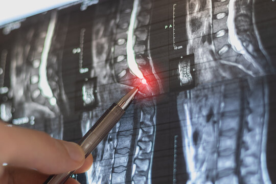 Doctor learning MRI of the lumbar spine.  At level 12, an arachnoid cyst measuring 13x14 mm is identified on the left.