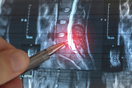 Doctor learning MRI of the lumbar spine.  At level 12, an arachnoid cyst measuring 13x14 mm is identified on the left.