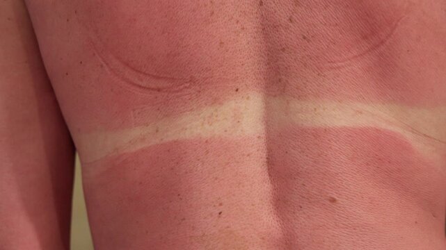 Sunburned female back with white bikini lines on red skin, highlighting the effect of sun exposure and tanning aftermath