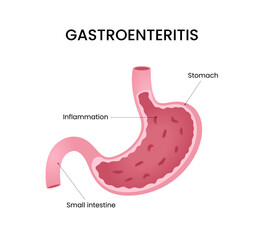 Gastroenteritis Stomach and Small Intestine Inflammation