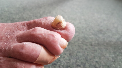 thickened, tall big toenail of a senior citizen, requires foot care