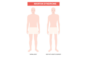 Marfan syndrome poster