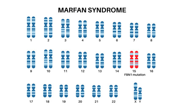 Marfan syndrome poster