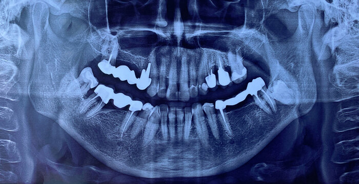 Close-up of image panoramic x-ray of teeth and jaw human