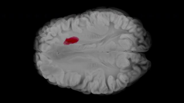 Axial animation of glioblastoma developing in the left frontal lobe. Tumor enlarges with tissue compression and progressive midline shift. Transparent background.