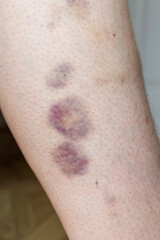 Multiple Purple and Yellow Bruises on Female Leg Indicating Injury or Trauma