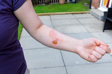 Healing Skin Burn Forming Scan on Woman’s Inner Forearm After Home Kitchen Accident