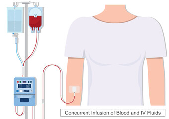 Concurrent infusions are the simultaneous infusion of multiple drugs.