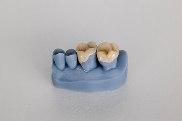 Close-up of blue dental cast showing tooth inlays and onlays. Concept of dental prosthetics, cavity...
