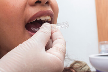 Dentist demonstrates and inserts clear aligners for a young female patient as part of modern...
