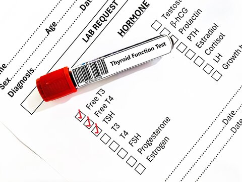 Blood sample tube and paper order request for thyroid function test analysis.