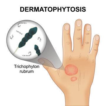 Dermatophytosis trichophyton rubrum skin infection