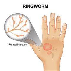 Ringworm fungal infection illustration on hand