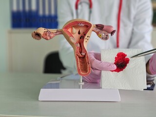 First menstruation in the uterus with a napkin with blood. Uterine bleeding symptoms treatment...