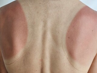 Sunburnt back showing red patches after a day outdoors, showcasing skin