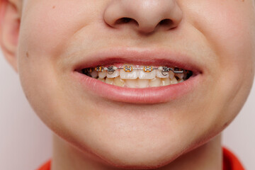 Closeup of smiling mouth with braces, dental care and orthodontics concept for straight healthy...