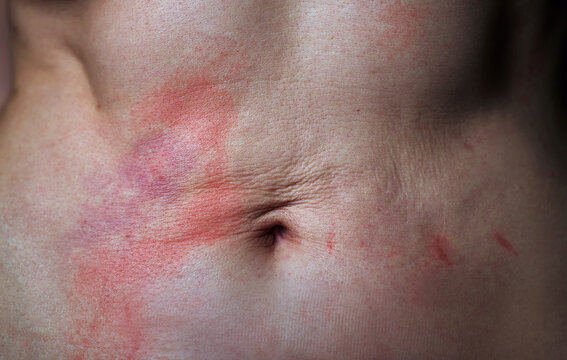 Close up of abdomen with psoriasis redness irritation and scar tissue