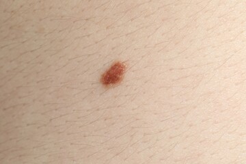 Woman with mole on her body, closeup