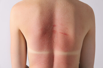Woman with peeling skin from sunburn on light background, closeup