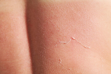 Fototapeta premium Woman with peeling skin from sunburn, closeup