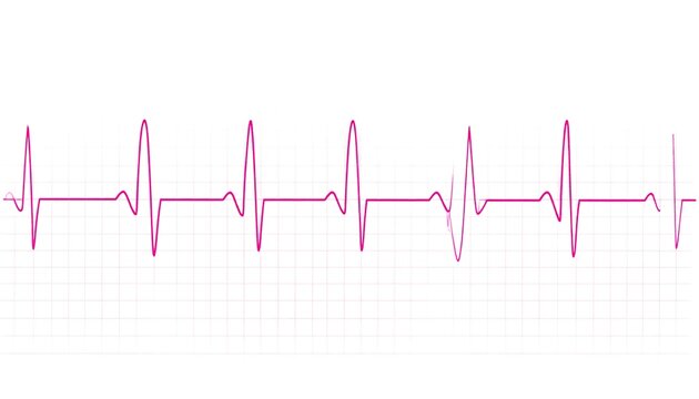 Pink EKG rhythm strip on gridded background
