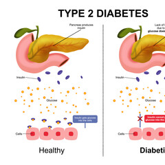 Type 2 Diabetes difference between healthy vs diabetic