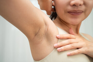 Asian woman have problem black armpit beauty skin care.
