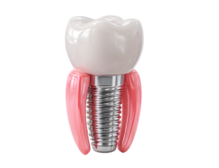  Tooth implant medical model Png transparent background