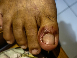 Appearance of the big toe of someone who has herpes