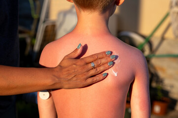 Applying soothing lotion to sunburned child with glucose monitor on the arm