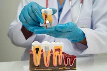 Dentist holding dental implant, artificial tooth roots into jaw, root canal of dental treatment, gum disease, teeth model for dentist.