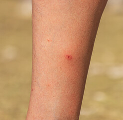 A person's leg has a red mark on it
