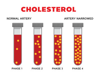 Cholesterol in artery, health risk , vector design